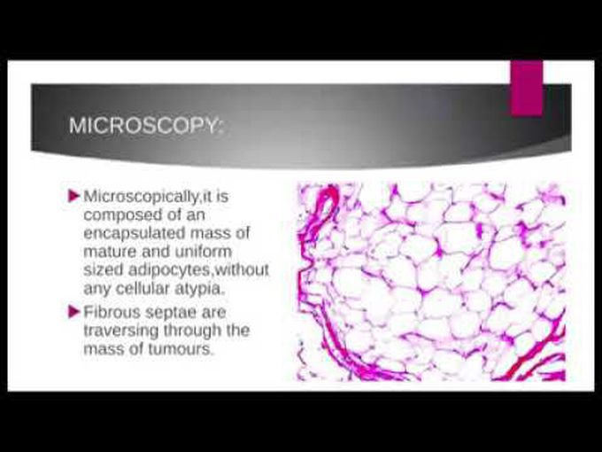 Lipoma vs Leiomyoma