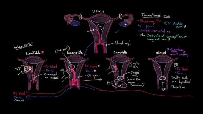 Basics about Miscarriage
