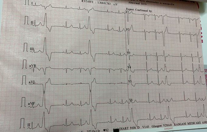 ECG interpretation