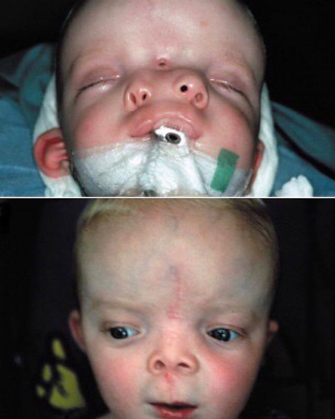 Little Soldier with Craniofacial Duplication!