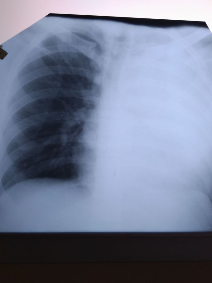 Lung x-ray