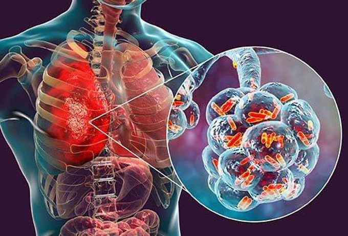 Pneumonia is a lung infection that can range from mild to so - MEDizzy