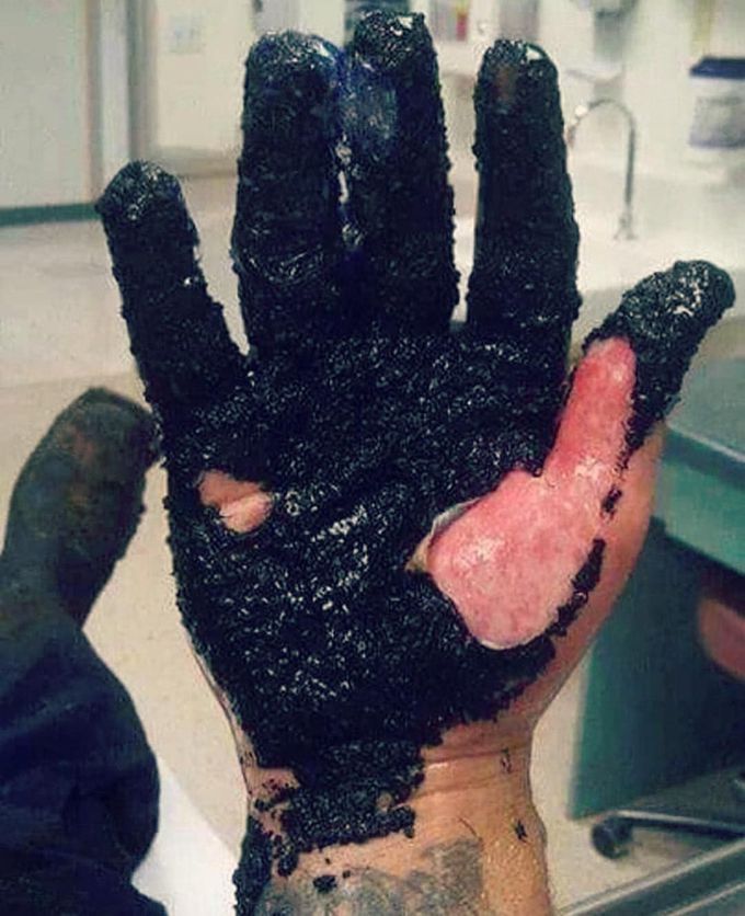 Here is a serious case of asphalt burn