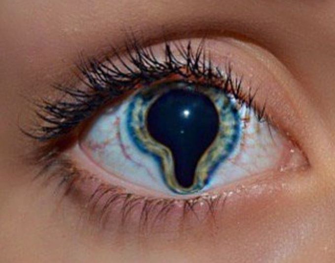 Coloboma