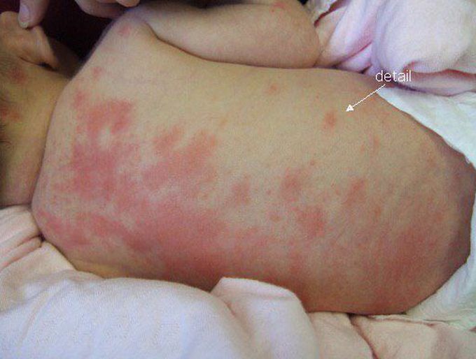 Erythema toxicum