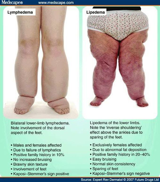 Lymphedema vs lipedema