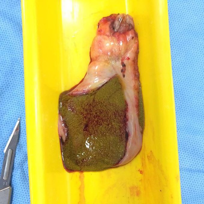 Gallbladder and its sludge taken through laparoscopic cholecystectomy