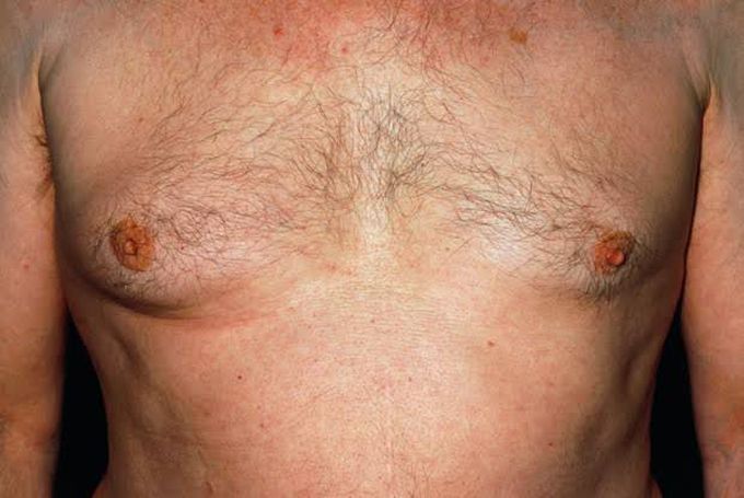Breast cancer in males