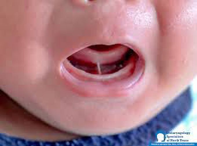 Ankyloglossia