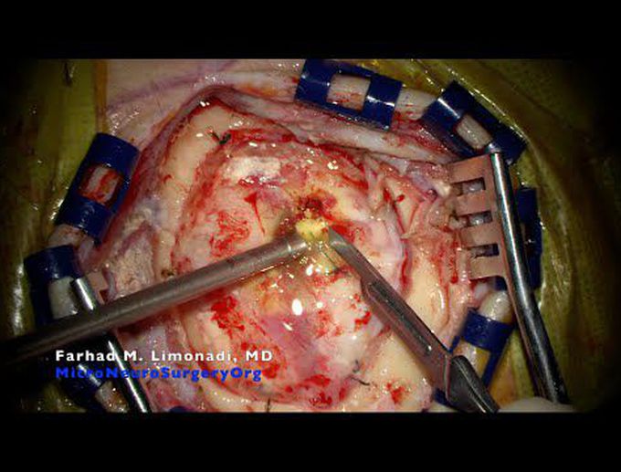 Brain tumor surgery: Recurrent Glioblastoma Multiforme (GBM) and surgical management