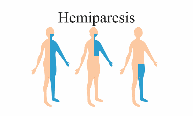 Hemiparesis