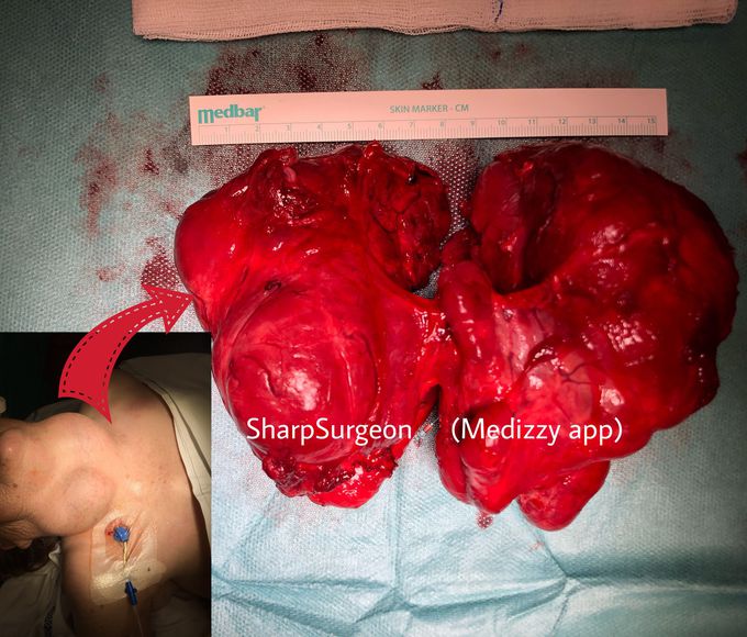 Thyroid enlargement and airway obstruction caused by a non-toxic goiter 🤯