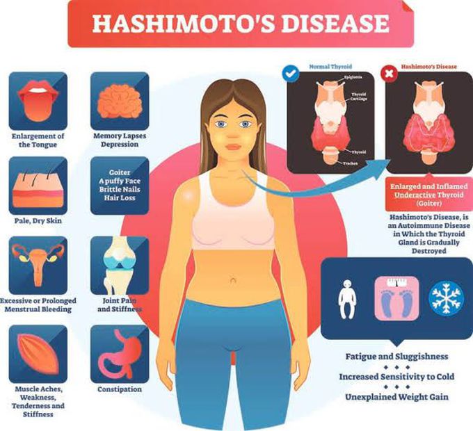Symptoms of hashimotos disease