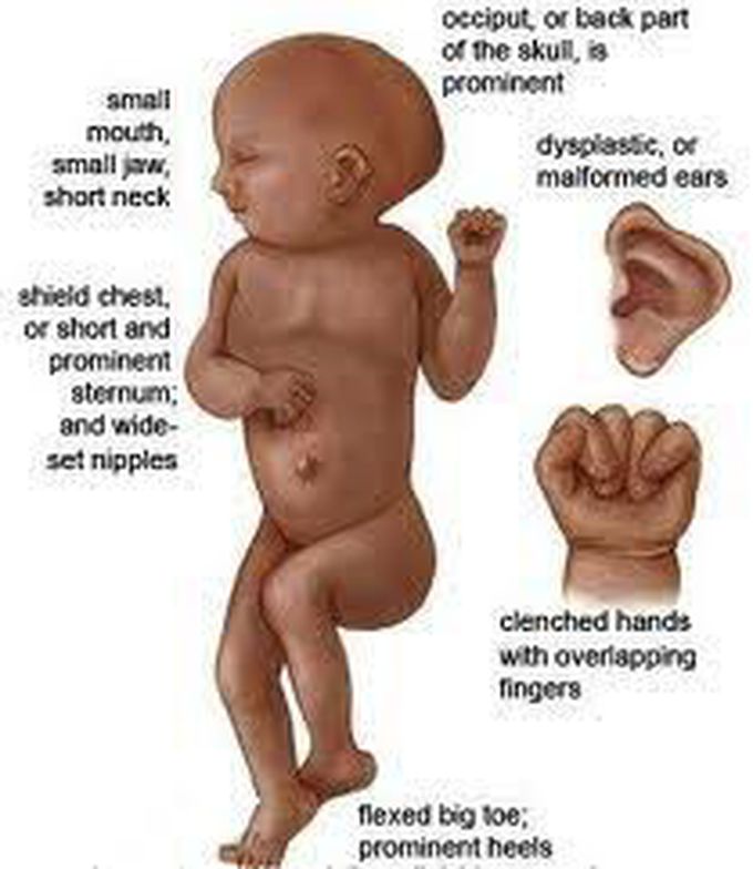 Mental Symptoms Of Edwards Syndrome