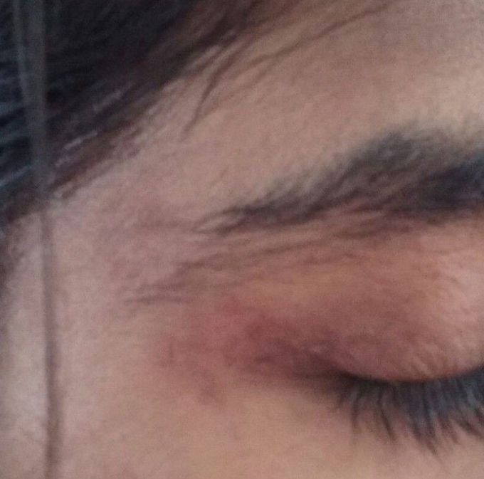 Rashes near the eye , forehead and forearm and arm