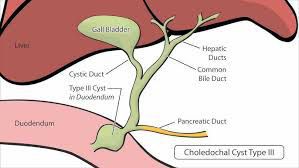 Choledochal cyst - MEDizzy