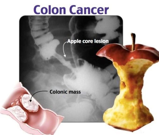 Colon Cancer Radiology