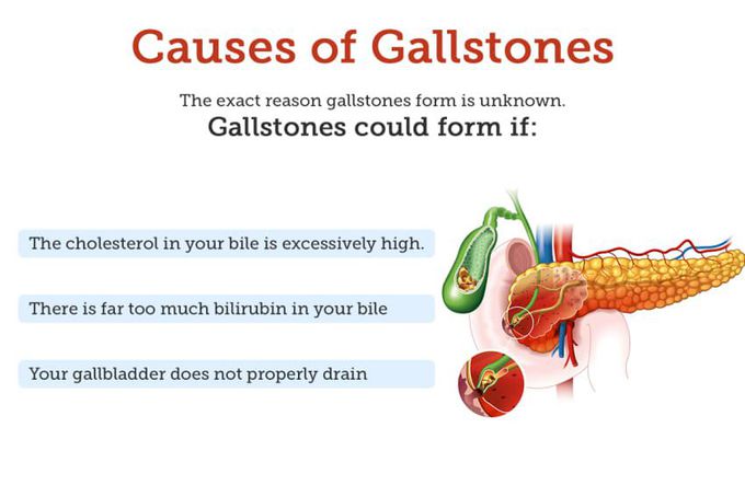 Causes of Cholelithiasis