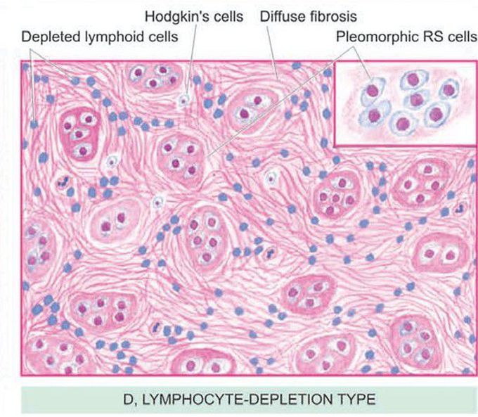 Lymphocyte depletion type(hodgekin's lymphoma)