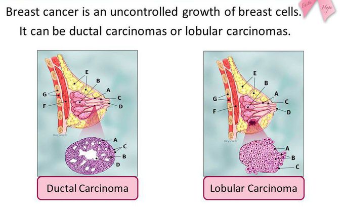 Breast cancer