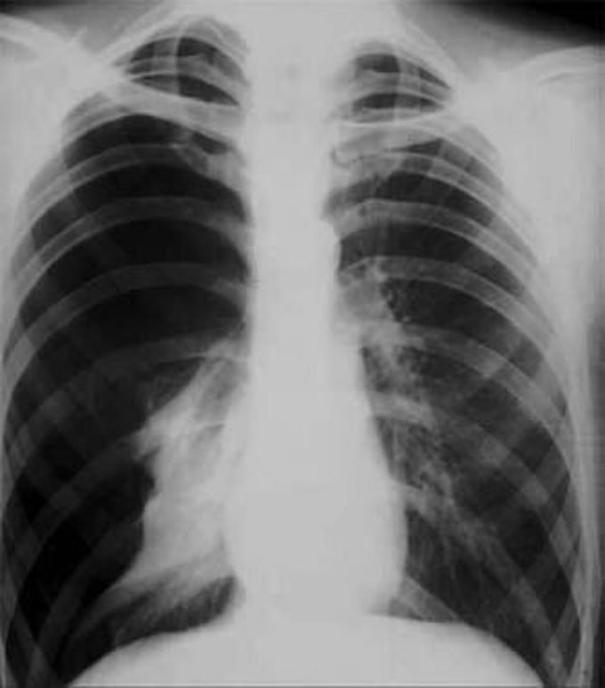 Radiograph of a patient with a complete right-sided pneumothorax due to a stab wound.