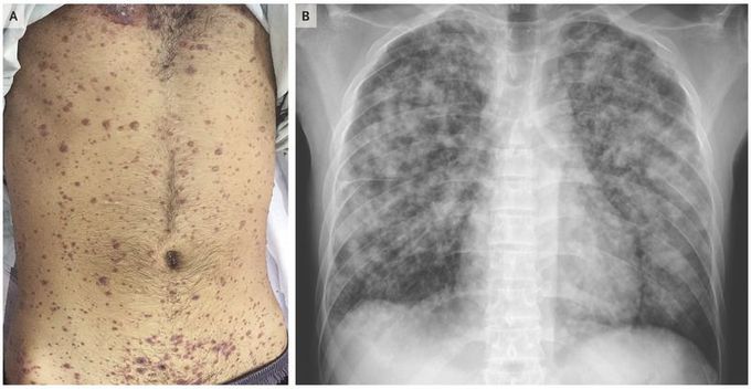 Disseminated Varicella Infection