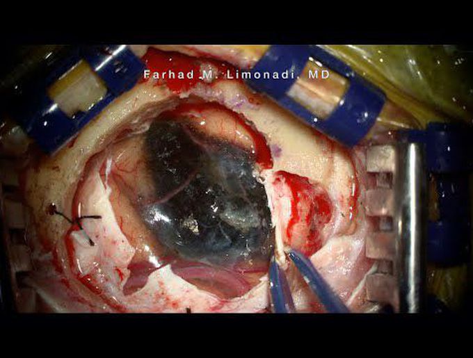 Surgical resection of two metastatic melanoma of the brain. Brain Surgery