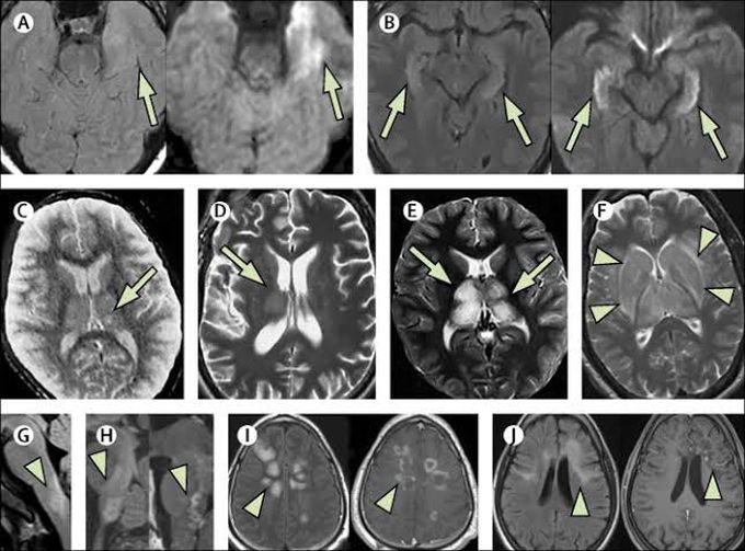 Encephalitis