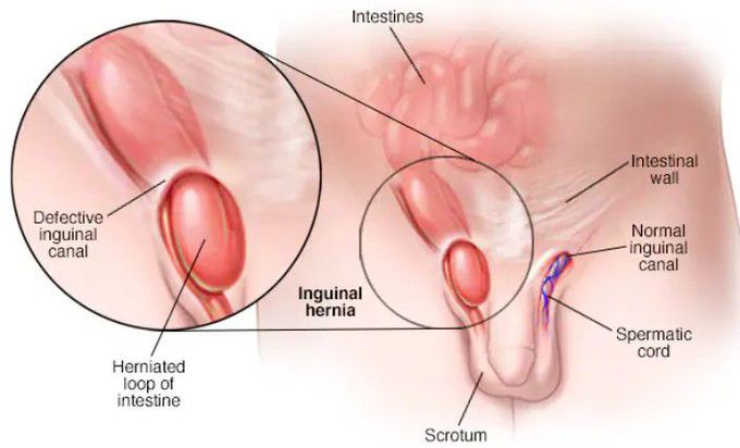Symptoms of Inguinal hernias