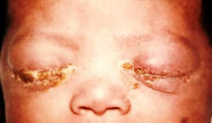 NEONATAL CONJUNCTIVITIS