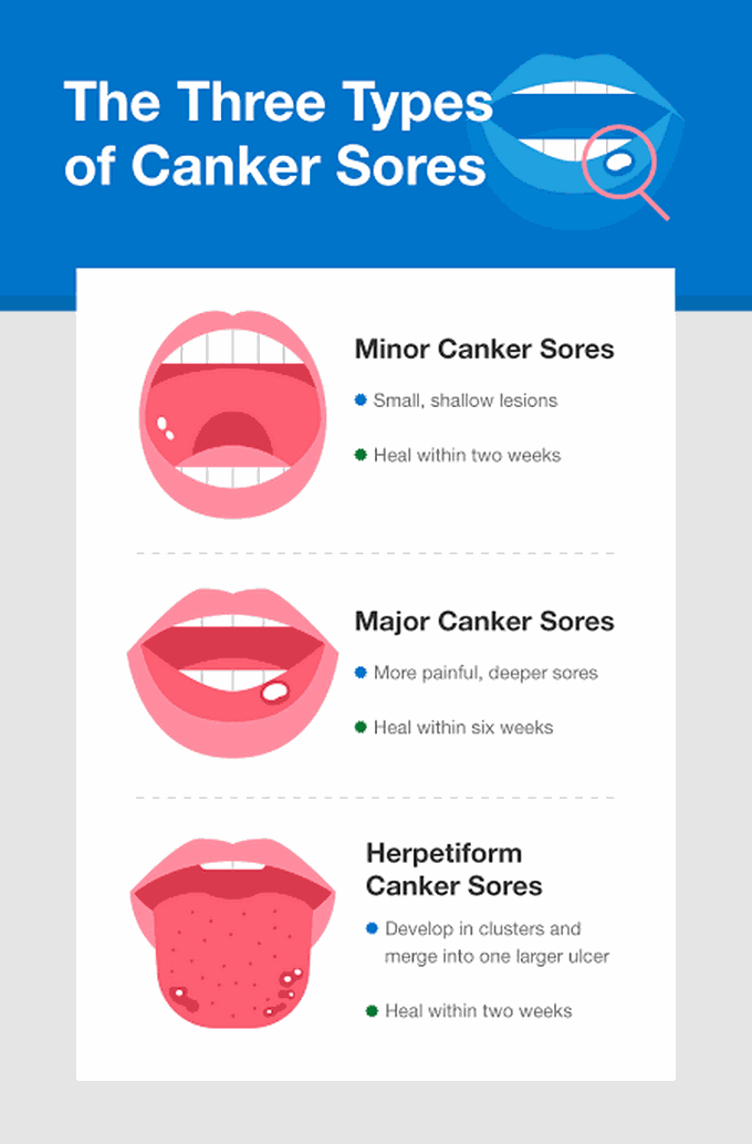 Types of canker sores