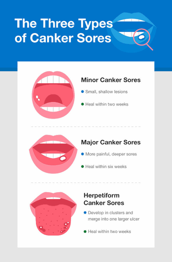 types-of-canker-sores-medizzy