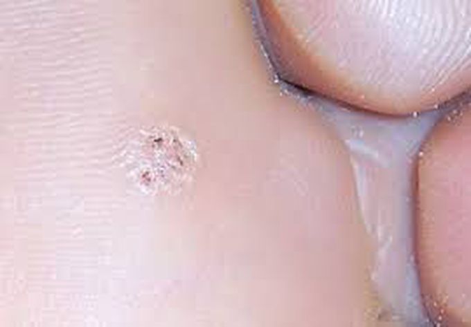 Symptoms of warts