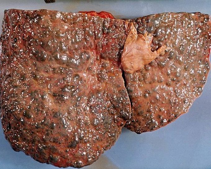 Liver cirrhosis