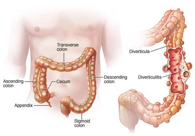 Diverticulitis