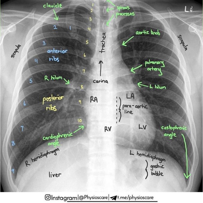 Chest X-Rays
