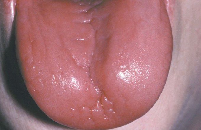 Plummer-Vinson Syndrome.