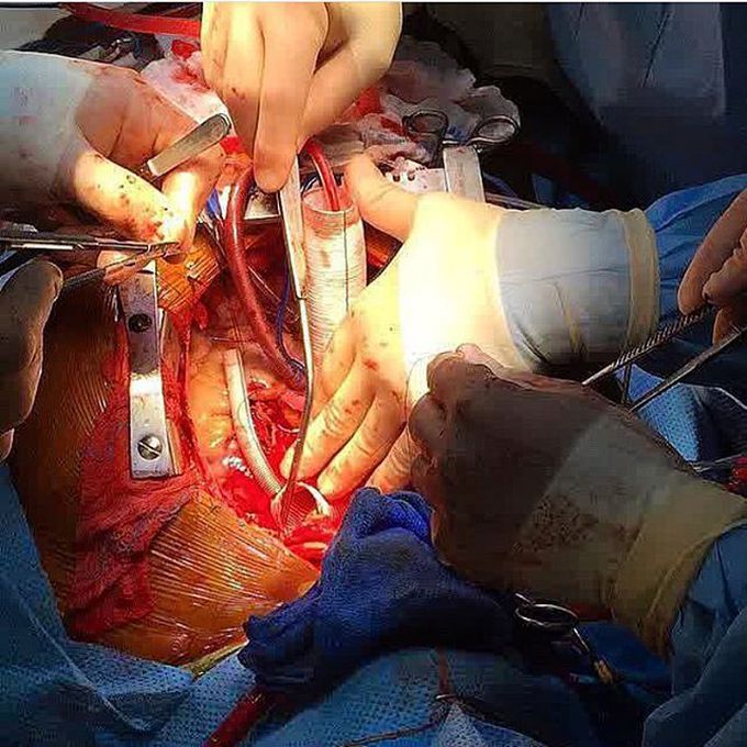 Thoracic aortic arch replacement surgery!  