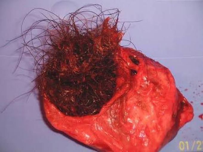 Teratoma