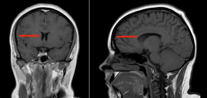 Treatment of pseudotumor cerebri