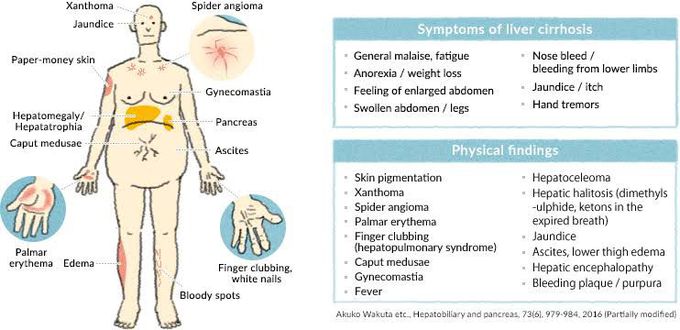 Signs of compensated cirrhosis