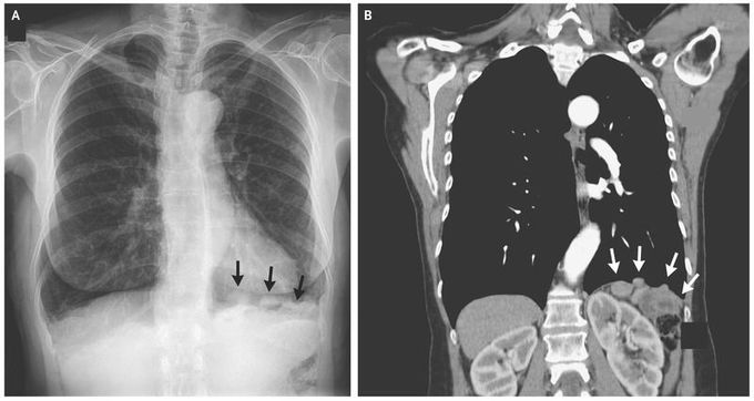 Splenosis Mimicking Cancer