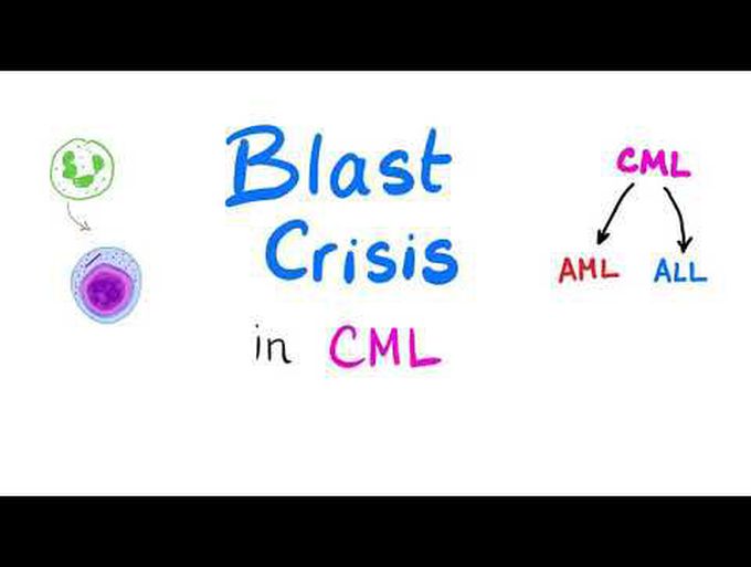 Blast Crisis in CML