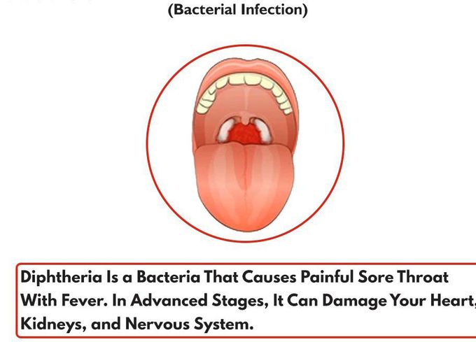 Cause of Diphtheria