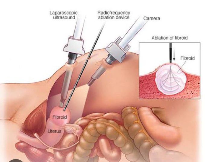 Treatment for Uterine fibroids