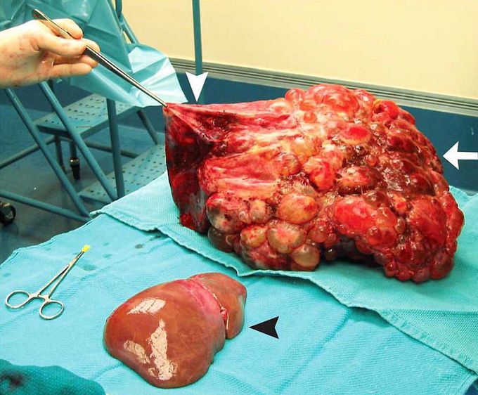 Liver transplantation for an extensive polycystic liver disease!  