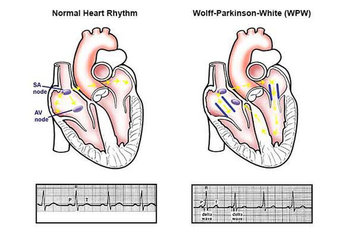 Wolff Parkinson's white syndrome