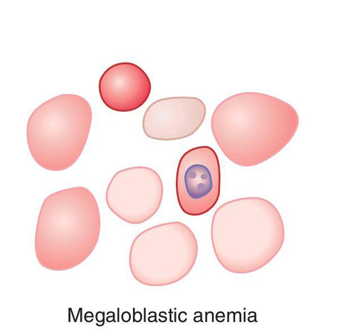 Characteristics of RBCs in different types of anemias.(3)