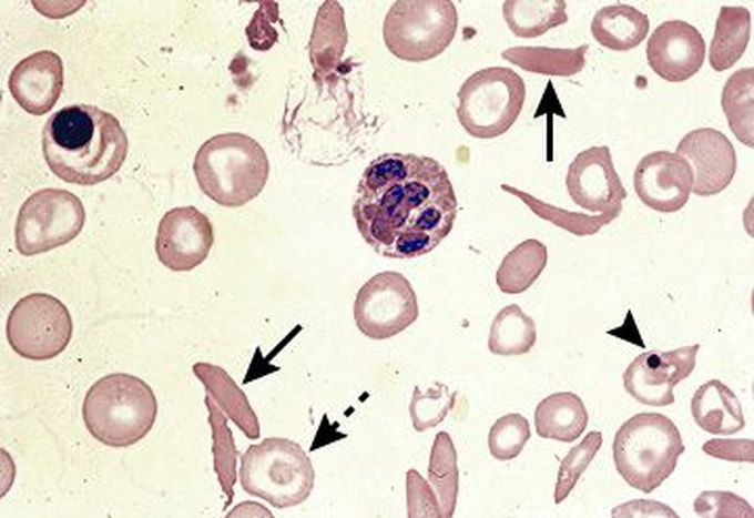 Peripheral Blood Smear Indicating Sickle Cell Disease