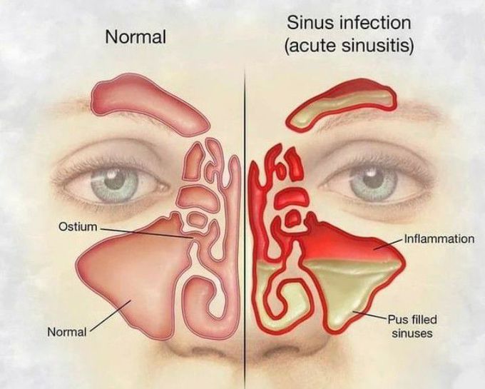 Sinus infection